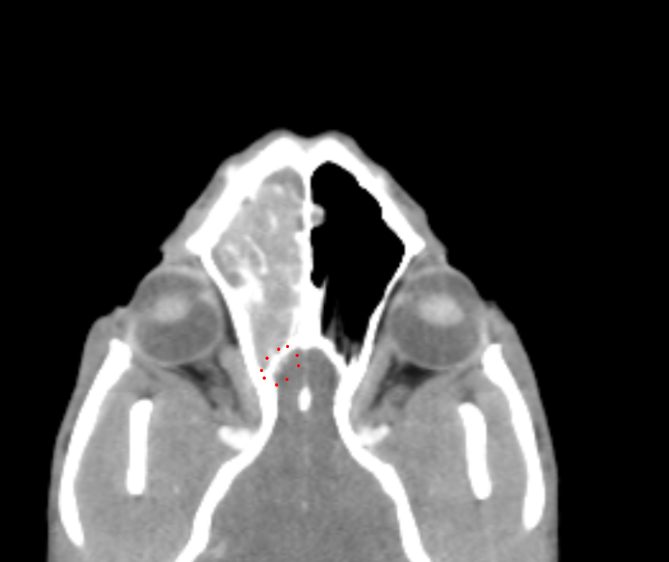 CT Nasal Example Image 2